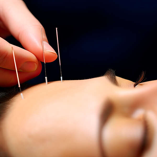 Akupunktur gegen Stress